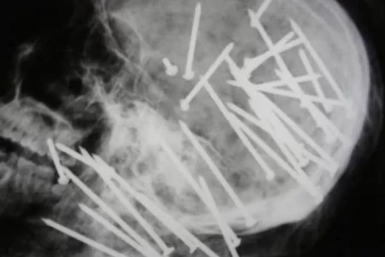 VIRAL! Foto Tengkorak Kepala Chen Liu Ada 34 Paku yang Tertancap, Apakah Asli atau Hasil AI?