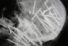 VIRAL! Foto Tengkorak Kepala Chen Liu Ada 34 Paku yang Tertancap, Apakah Asli atau Hasil AI?